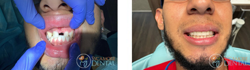Dental Bridges Before & After Case 01
