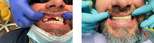Dental Bridges Before & After Case 02