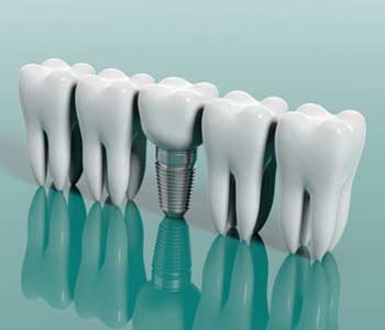 Does Insurance Cover Dental Implants in Fort Worth TX area