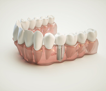 Why patients in Fort Worth TX choose to replace a single tooth with an implant, rather than a dental bridge