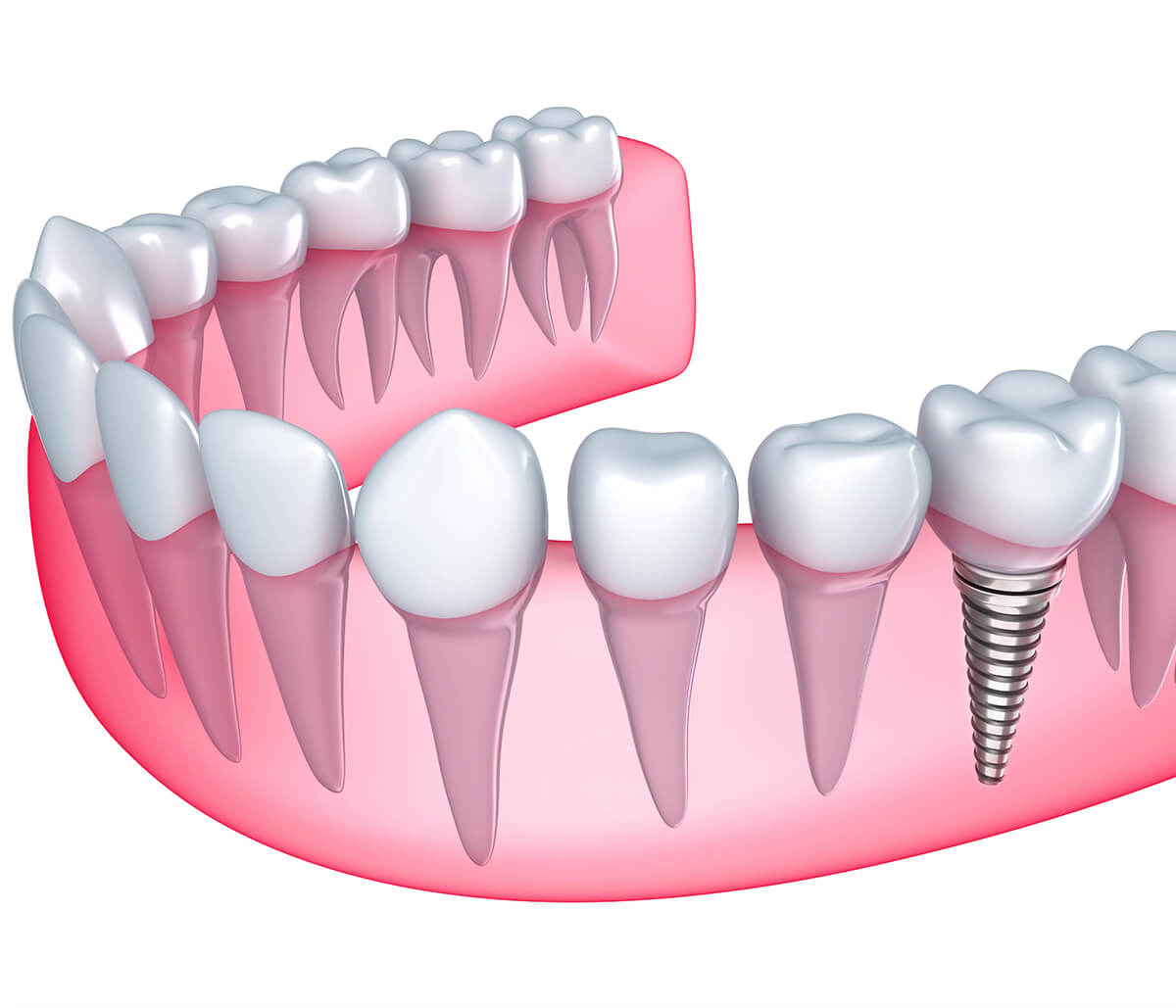 1, 2, 3 steps to replace a tooth, a mouthful of teeth with the dental implant procedure in Fort Worth, TX