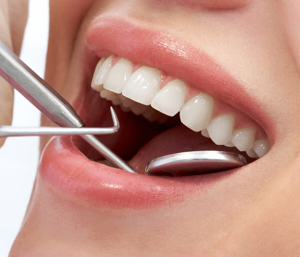 How to Care for Porcelain Veneers in Fort Worth, TX