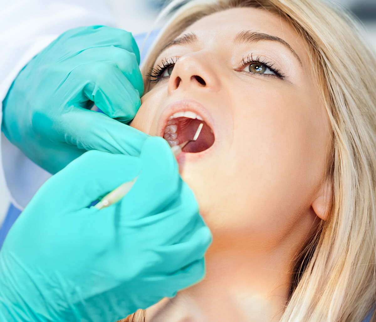 Wisdom Tooth Extraction Dentist in Fort Worth TX Area