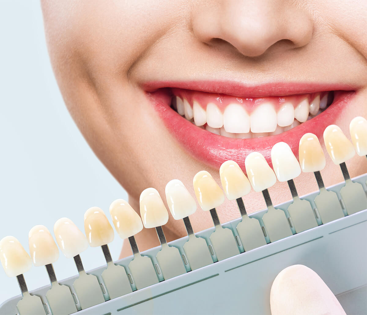 Porcelain Veneers, The Natural-looking Solution to A Beautiful Smile