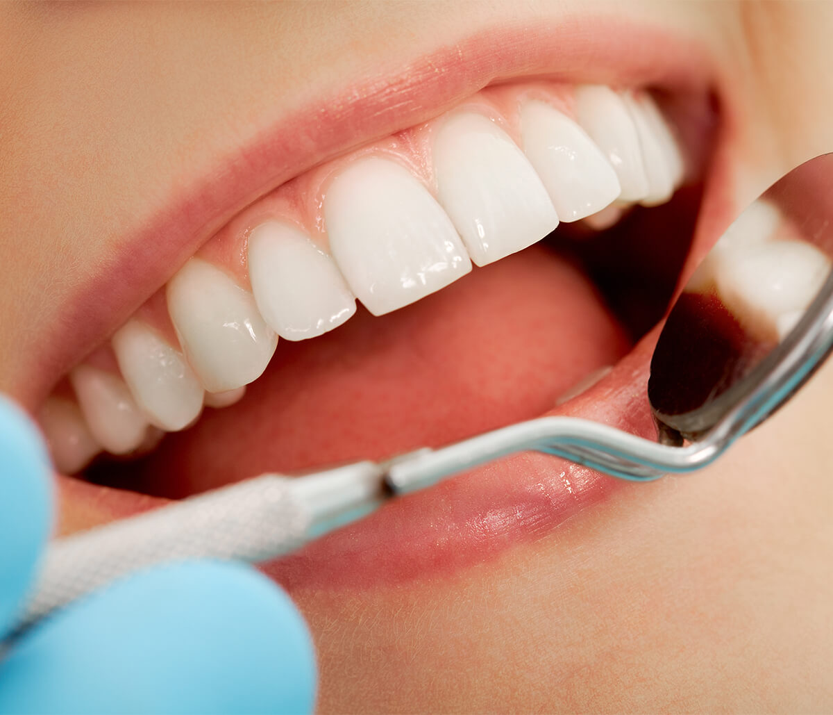 Advantages of Dental Veneers Over Other Procedures