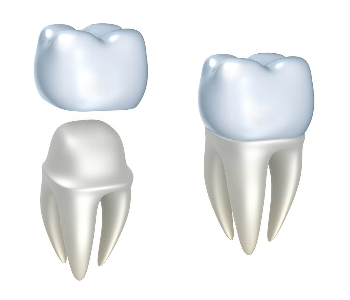 Natural Looking Dental Crowns in Fort Worth TX Area