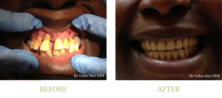 Dentures Before and After Results in the area by Best Dentist 