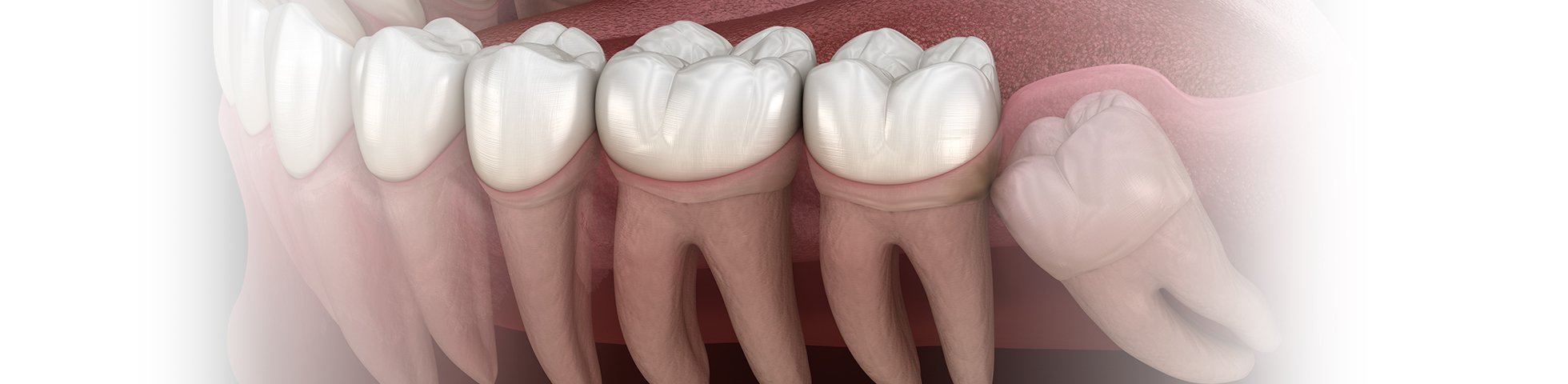 Wisdom tooth extraction from the dentist you trust in Fort Worth