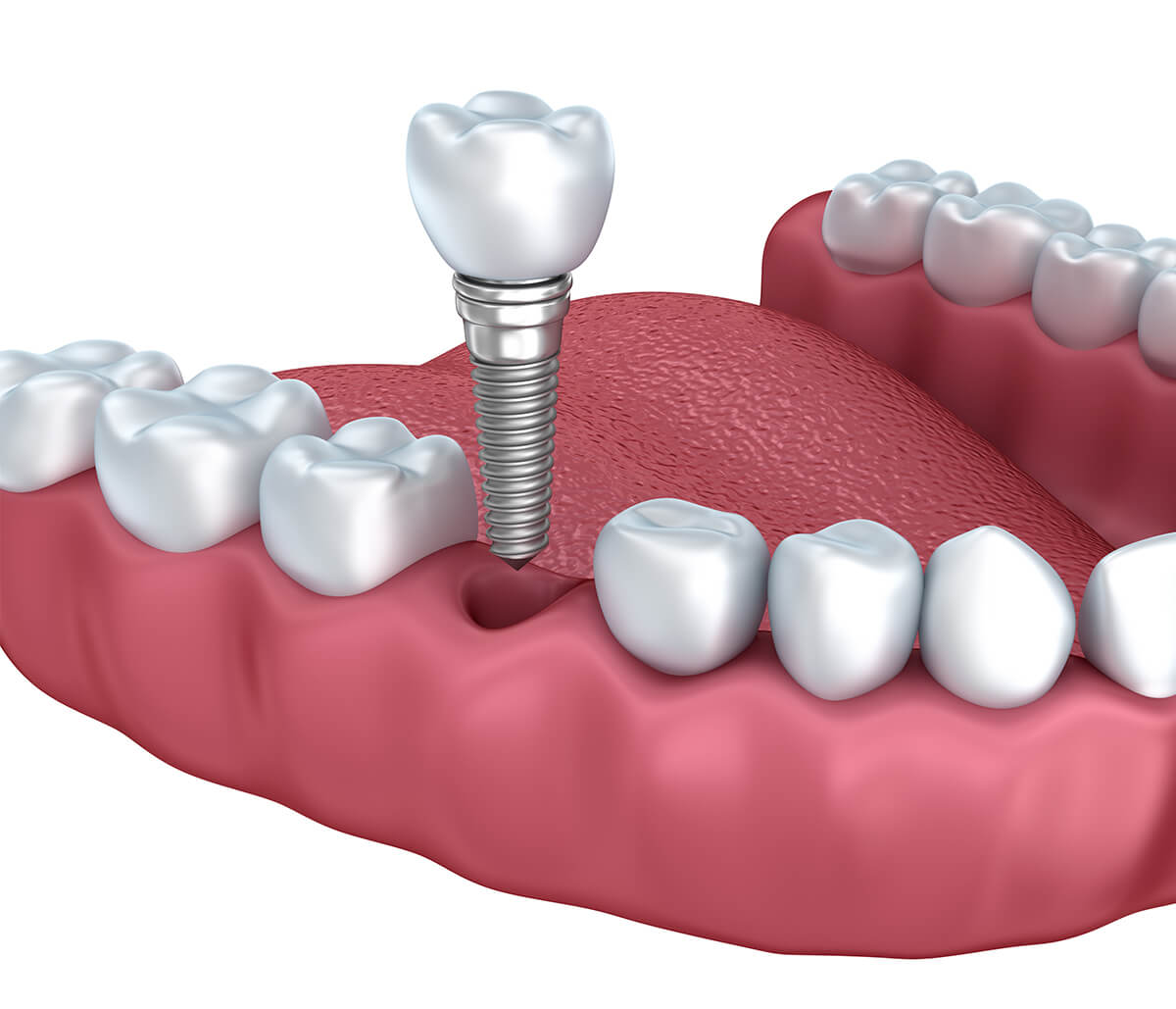 Restoring a lifetime of happy, healthy smiles with dental implant crowns, bridges, and dentures