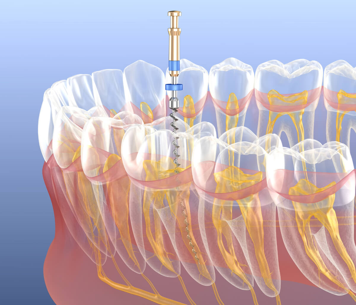 Emergency Root Canals in Fort Worth TX area